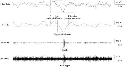 Association Between Interictal High-Frequency Oscillations and Slow Wave in Refractory Focal Epilepsy With Good <mark class="highlighted">Surgical Outcome</mark>
